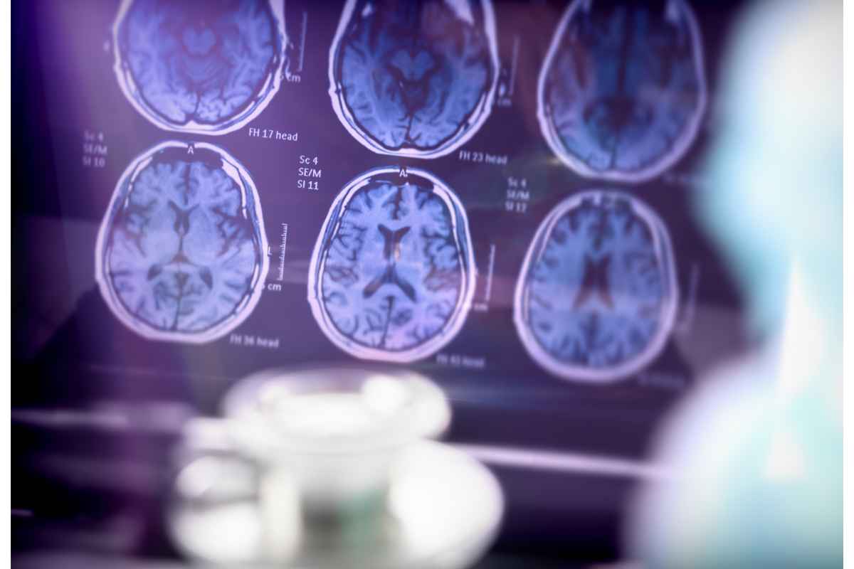 Risultati analisi TAC del cervello di un individuo affetto da Alzheimer